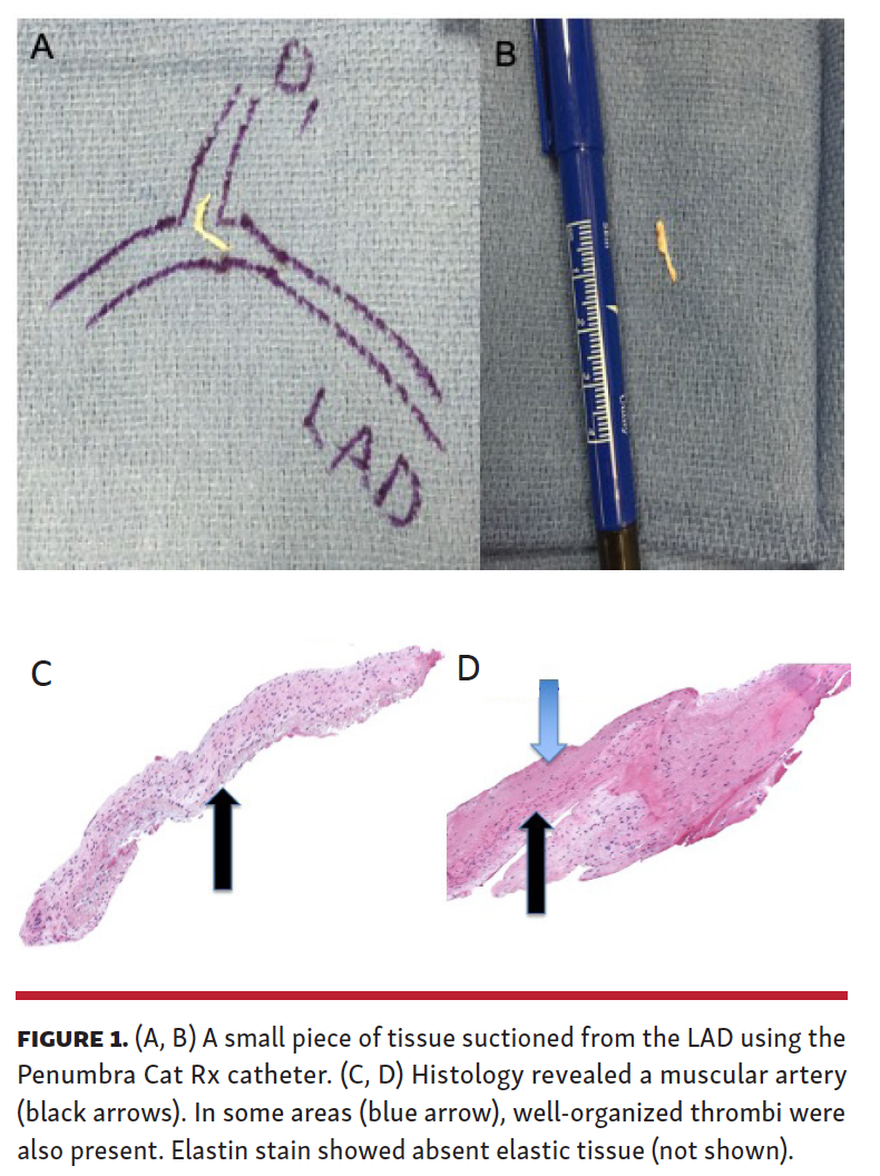 Successful Mechanical Aspiration of Embolized Vessel Fragment During